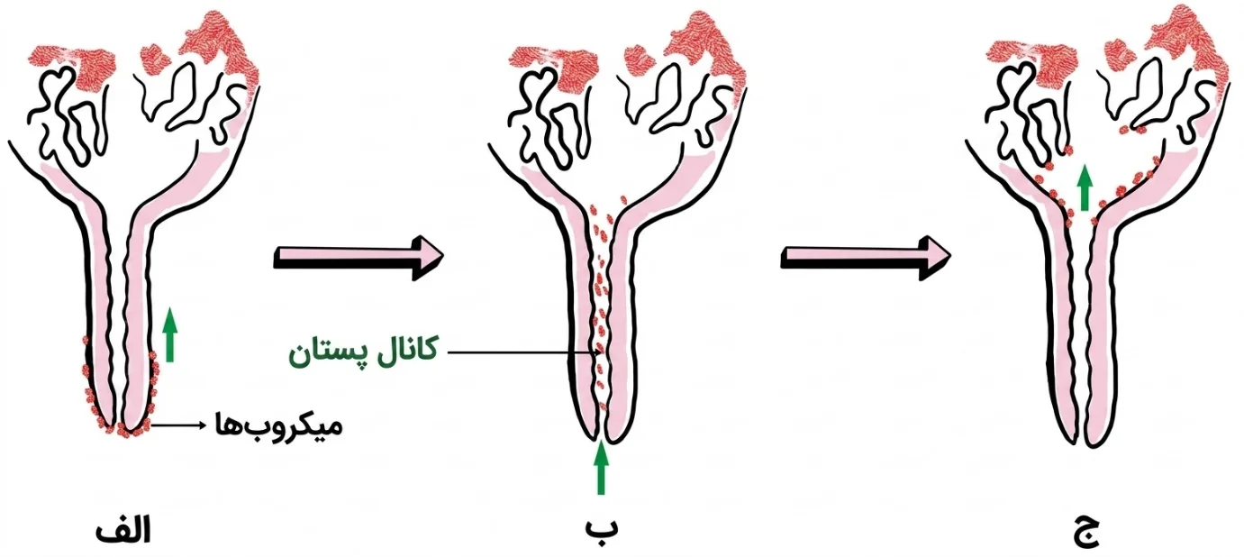 مسیر ورود میکروبها از مجرای سرپستانک و ایجاد عفونت
